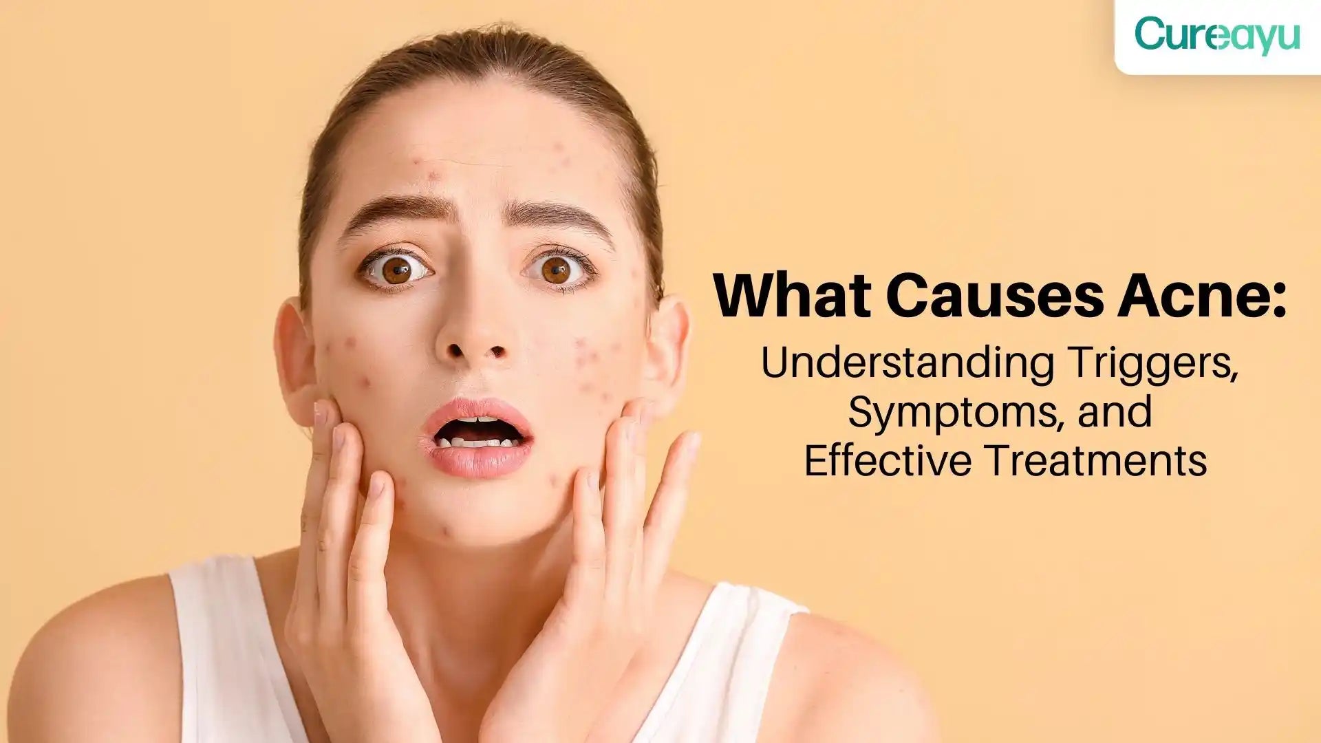 What Causes Acne: Understanding Triggers, Symptoms, and Effective Treatments