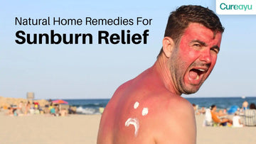 home remedies for sunburn