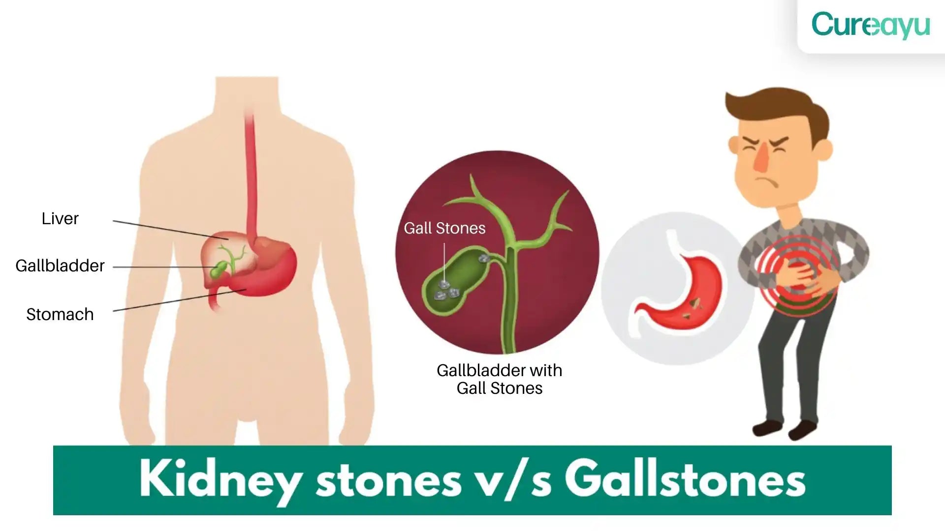 bladder stones vs kidney stones