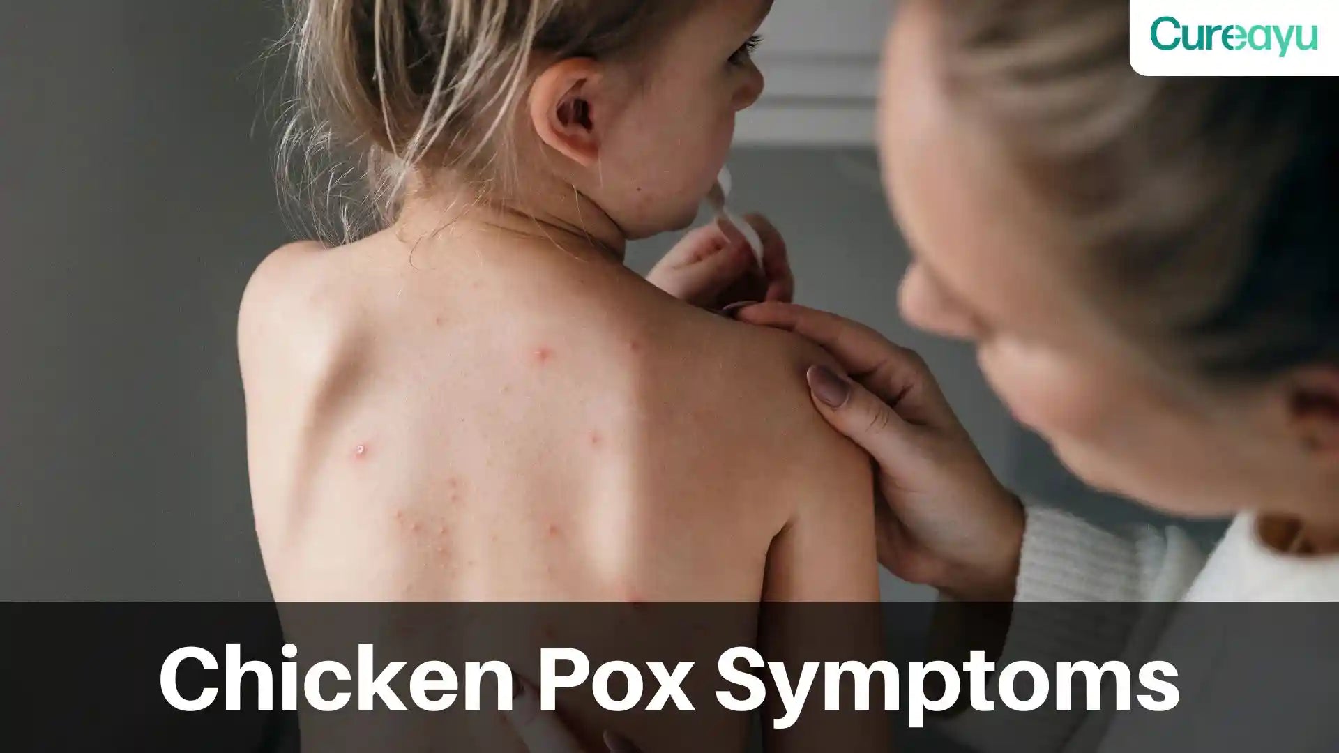 chicken pox symptoms