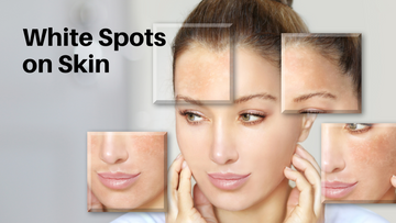 Understanding White Spots on Skin: Causes, Treatments, and Should You Worry?