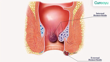 internal vs external hemorrhoids