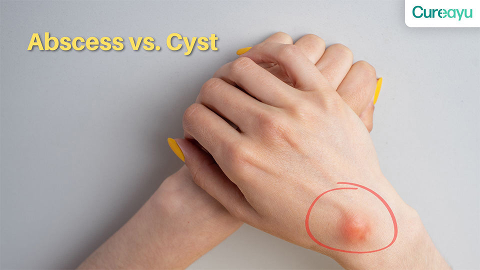 abscess vs cyst