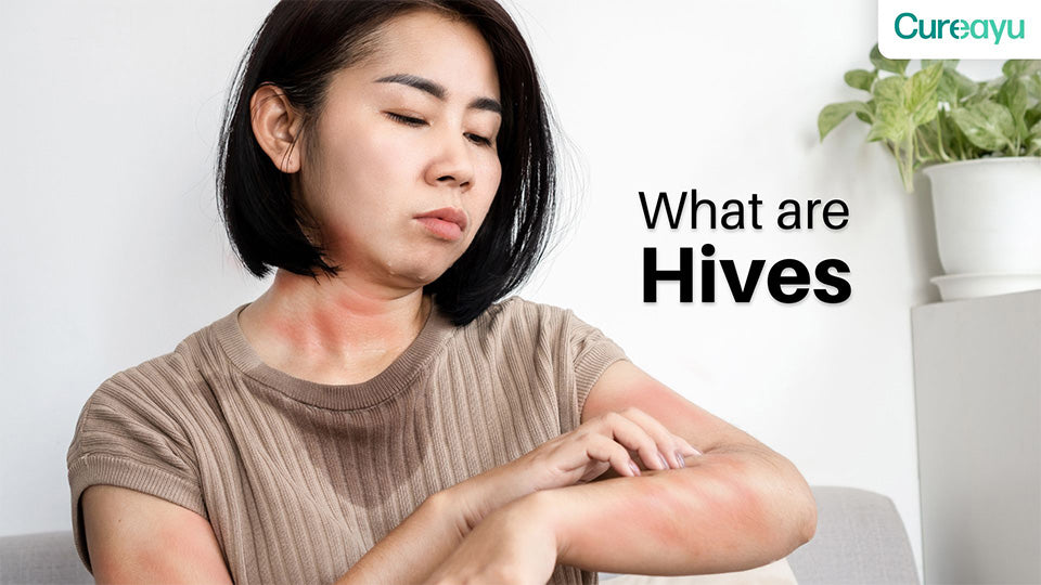 What Are Hives: A Complete Guide to Causes, Symptoms, and Treatment ...